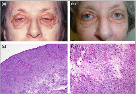 Necrobiotic Xanthogranuloma Histology