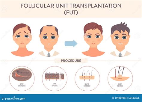 Fut Hair Transplantation Procedure Medical Infographic Poster Stock