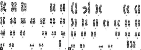 Karyotype Of A Female With A 45 Xo And B 47 Xxx Chromosomal