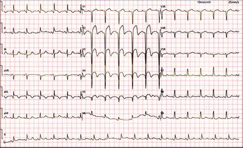 Ecg Of Acute Extensive Anterior Myocardial Infarction In A Patient With