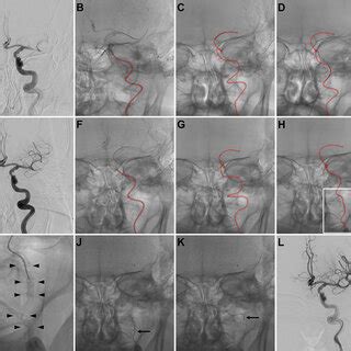 Imaging Findings Before Thrombectomy DWI A Of The Head Before