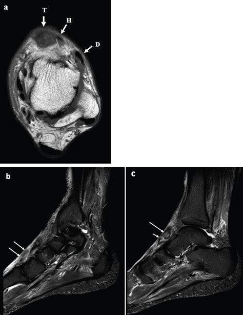 Tibialis Anterior Tendon Tear