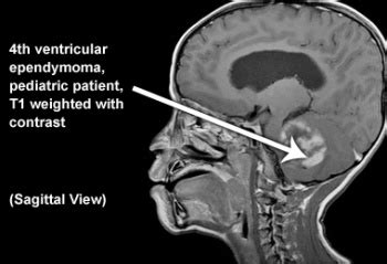 Ependymoma - Physiopedia