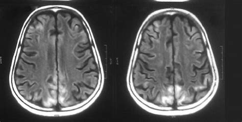 Posterior reversible leukoencephalopathy syndrome (PRES) | Deranged ...