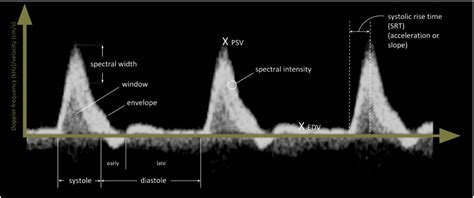 Spectral Doppler Ultrasound Of Peripheral Arteries A Pictorial Review Clinical Imaging