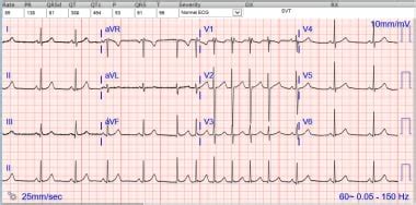 Av Nodal Reentrant Tachycardia