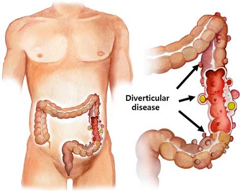 Sigmoid Colon Anatomy Location Function Polyps Diverticulosis And Cancer