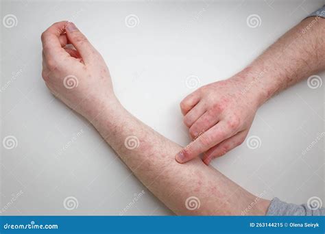 Itchy Rash On Arms