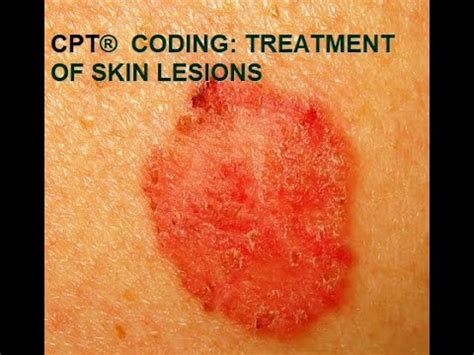 Cpt Coding For Skin Lesions Youtube