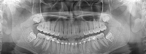 Inicio Oral Rx Diagnóstico Radiológico Radiografías Intraorales Radiografías Extraorales