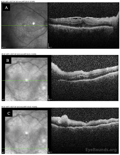 Eyerounds Org Bilateral Acute Retinal Necrosis