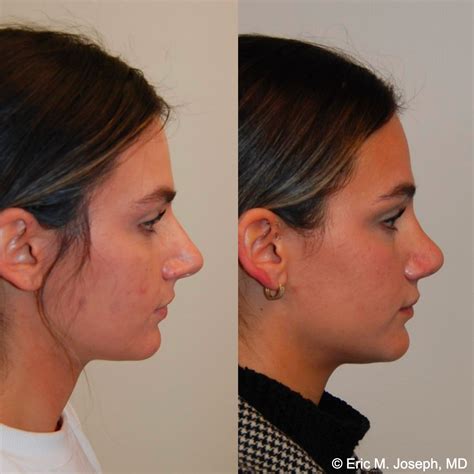 Eric M Joseph Md Rhinoplasty Before After Results With