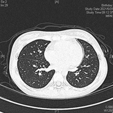 Chest High Resolution Computed Tomography Hrct Images Reveal Download Scientific Diagram