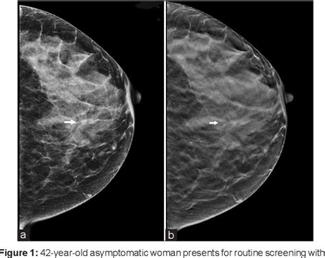 Figure 1 From Initial Experience With Combination Digital Breast