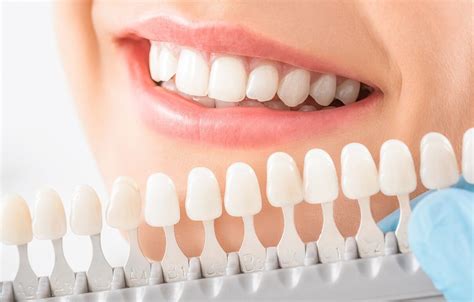 Tooth Colored White Fillings Dental Clinic In Lucknow Mint Dental