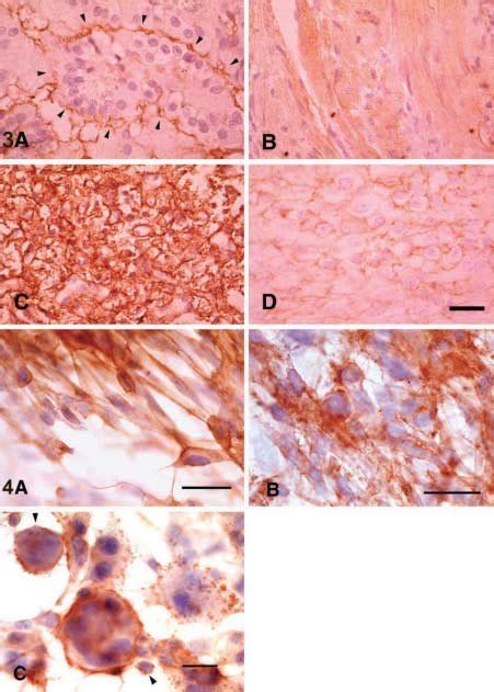 Immunostaining Of Solid Benign Tumors Probed With Anti CD9 Antibody