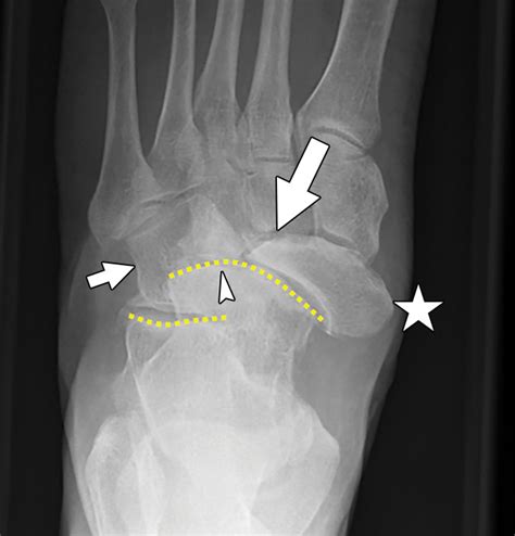 Imaging Of Mueller Weiss Syndrome A Review Of Clinical Presentations