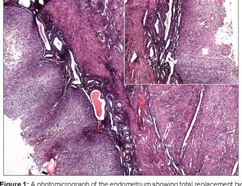 Figure 1 From Unusual Form Of Squamous Cell Carcinoma Of The Cervix Extending In Situ Into The