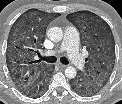 Pcp Pneumonie Pneumocystis Pneumonia Ct Scan Stock Image C Hot Sex