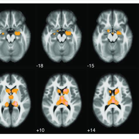 Statistical Parametric Map Overlaid On An MRI Template Neurological