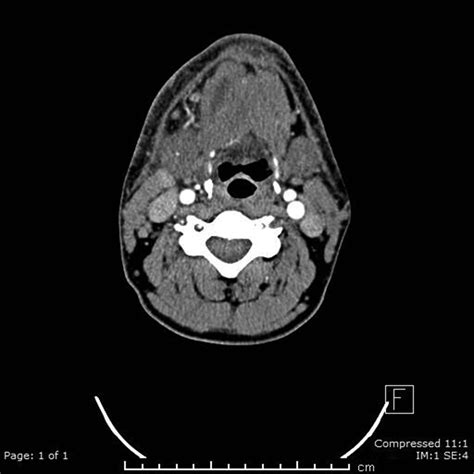 Abscess Of The Anterior Belly Of The Digastric Muscle A Case Report