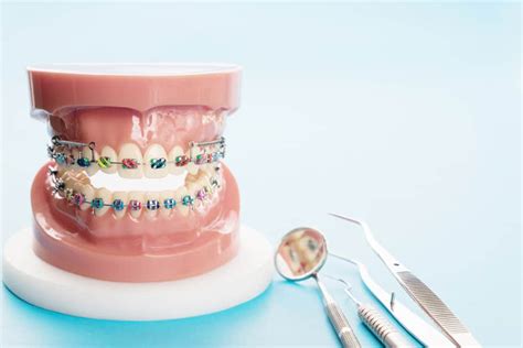 ORTODONCIA FIJA CÓMO FUNCIONAN LOS BRACKETS METÁLICOS CONVENCIONALES