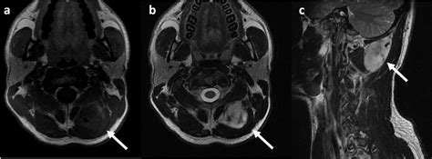 Magnetic Resonance Imaging View Of Spindle Cell Lipoma T1 Axial A