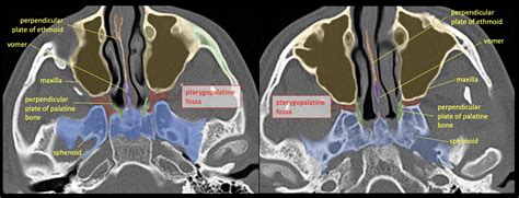 Pterygopalatine Fossa Diagram