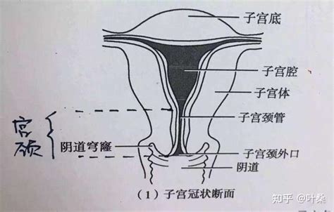 宫颈cin解读 知乎