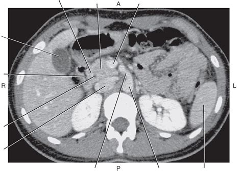 Diagram Of Axial CT Of Abdomen With CBD Quizlet