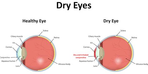 Dry Eye Syndrome - La Pine Eyecare Clinic