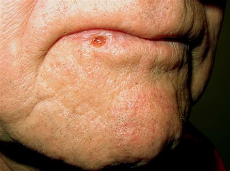 Skin Cancer On Lip