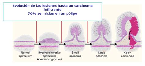 Prevención de cáncer de colon y recto en Barcelona: comienza la cuarta