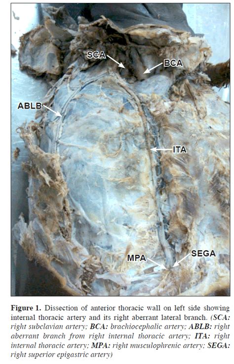 An aberrant right lateral branch from right internal thoracic arteryside