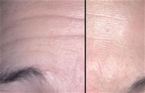 Wrinkle Fillers – Best Deep, Instant Injectable, Topical & OTC Face ...