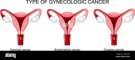 Type Of Gynecologic Cancer Ovarian Endometrial And Cervical Cancer Diagram Shows Cross