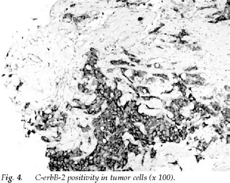 Figure 1 From Primary Squamous Cell Carcinoma Of The Breast A Case