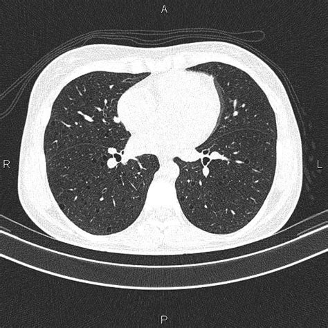 Lymphangioleiomyomatosis Image Radiopaedia Org