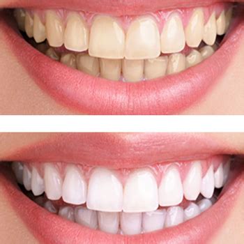 5 Astuces Pour Blanchir Ses Dents Naturellement Artofit