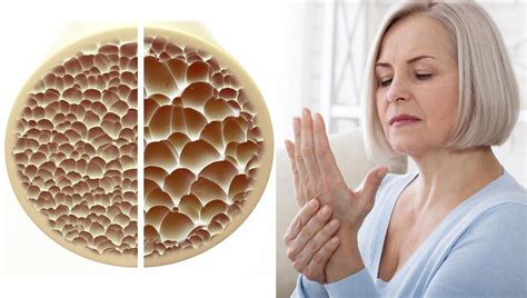 Osteoporosis Factores De Riesgo Y Diagnostico