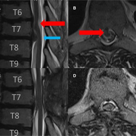 Preoperative Sagittal A And Axial B T2 Weigthed MRI Revealed A