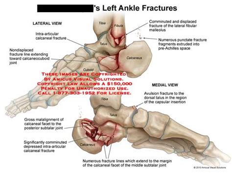 Amicus Illustration Of Amicus Injury Ankle Fractures Intra Articular