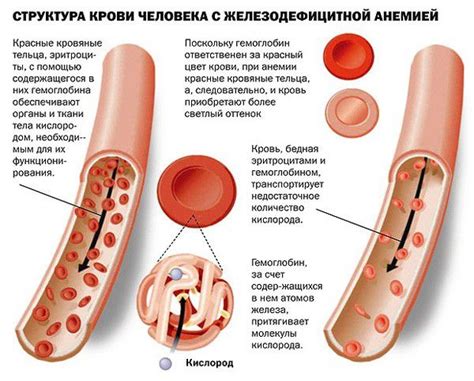 Дефіцит заліза в організмі: симптоми і лікування