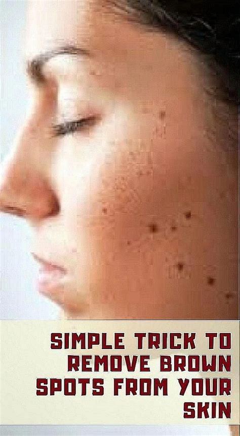 How To Get Rid Of Brown Spots On Head A Comprehensive Guide The