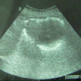 Abdominal CT showing trabeculated bladder wall the patient died two ...