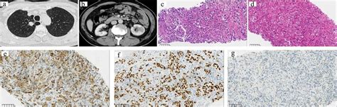 Renal Metastasis From Primary Lung Small Cell Carcinoma From Case A