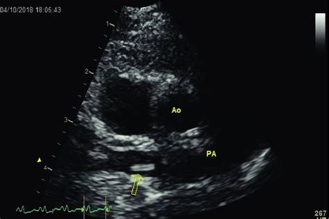 Echocardiogram Showing Heartworms Seen As Short Segmented Strongly