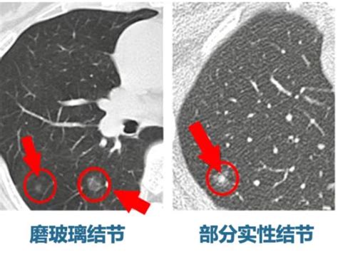 今天手术明天出院，3种“黑科技”精准解决肺结节！