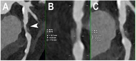 Jcm Free Full Text Dual Source Photon Counting Computed Tomography