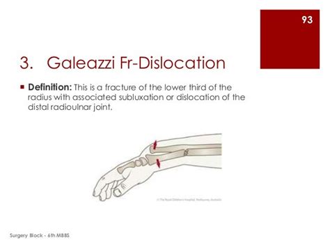 Ao classification of galeazzi fracture - yiquest